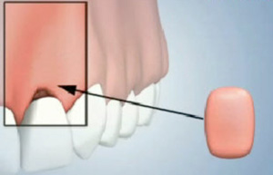 Gum Tissue Augmentation