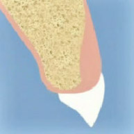 Gum Tissue Augmentation NYC