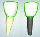 Dental Implant Crown