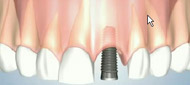 Placement of Dental Implants