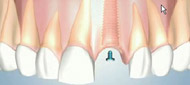 Dental Implant Osseointegration