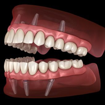 All-On-4 Dental Implants