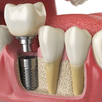 Single-Tooth Replacement