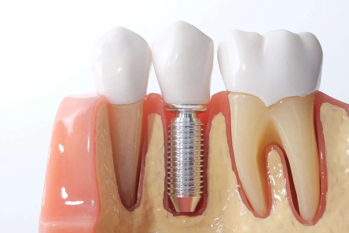 Single dental implant supported crown